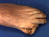 toe flap