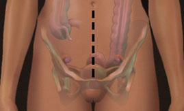 Lower Midline Incision