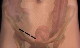 Groin Incision