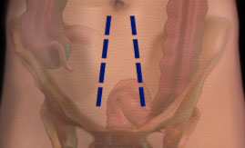 Paramedian Incision