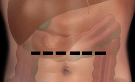 Transverse Incision