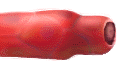 clotted vessel