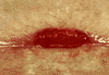 granulation tissue