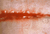 scar